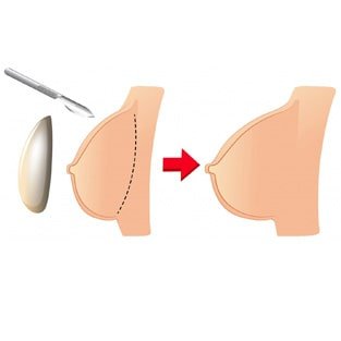 https://bestplasticsurgeryindia.com/wp-content/uploads/2023/12/Breast-Reduction-min.jpg
