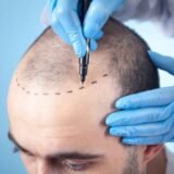 Best Hair Transplant Clinic in Chandigarh